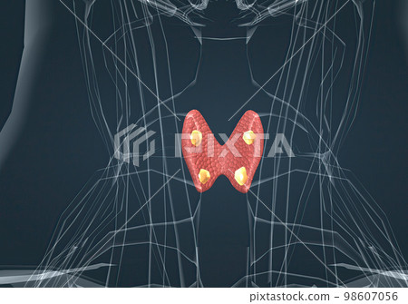 The thyroid gland is an endocrine gland found in the neck in humans and consists of two interconnected lobes. The thyroid gland is an endocrine gland found in the neck in humans and consists of two interconnected lobes. 98607056