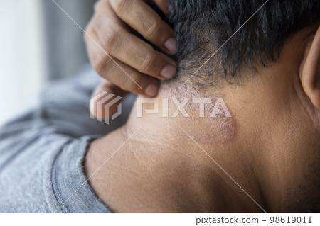 Dark-skinned Asian men suffer from scalp dermatitis due to moisture-causing fungi. fungal itching. skin diseases-allergies, psoriasis, eczema, dermatitis. Dark-skinned Asian men suffer from scalp dermatitis due to moisture-causing fungi. fungal itching. skin diseases-allergies, psoriasis, eczema, dermatitis. 98619011