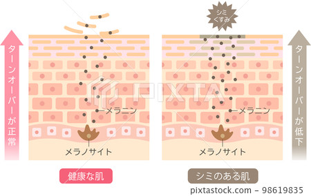 Mechanism of blemished skin Turnover Skin cells Before and after 98619835