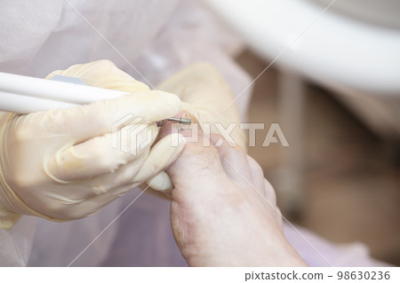 Treatment of toenail fungus in the hospital. 98630236