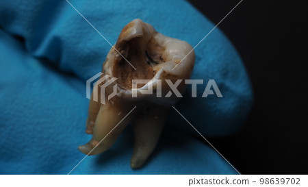 Tooth decay and dentist hand with glove and black background. Macro shot of a decayed teeth till root after extraction of dentist. Real tooth anatomy due lack of dental care. Top view of caries teeth 98639702