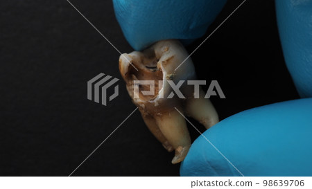 Tooth decay and dentist hand with glove and black background. Macro shot of a decayed teeth till root after extraction of dentist. Real tooth anatomy due lack of dental care. Top view of caries teeth 98639706