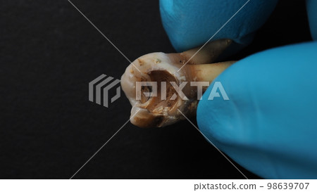 Tooth decay and dentist hand with glove and black background. Macro shot of a decayed teeth till root after extraction of dentist. Real tooth anatomy due lack of dental care. Top view of caries teeth 98639707