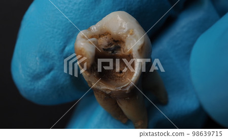 Tooth decay and dentist hand with glove and black background. Macro shot of a decayed teeth till root after extraction of dentist. Real tooth anatomy due lack of dental care. Top view of caries teeth 98639715