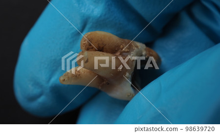 Tooth decay and dentist hand with glove and black background. Macro shot of a decayed teeth till root after extraction of dentist. Real tooth anatomy due lack of dental care. Top view of caries teeth 98639720
