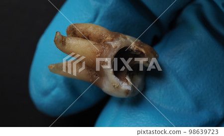 Tooth decay and dentist hand with glove and black background. Macro shot of a decayed teeth till root after extraction of dentist. Real tooth anatomy due lack of dental care. Top view of caries teeth 98639723