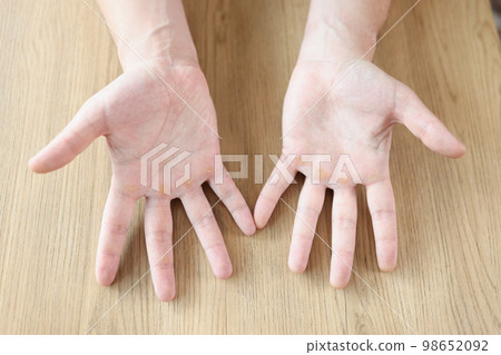 Many calluses on distal palmar surface of hands. Many calluses on distal palmar surface of hands. 98652092