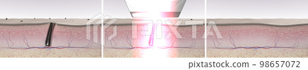 Skin before and after laser hair removal. 3d render 98657072