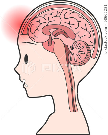 Pain such as subarachnoid hemorrhage and headache in cross section of human brain 98665281
