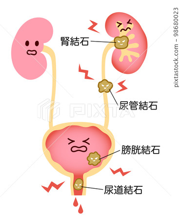 腎臟和膀胱的插圖由於尿路結石而顯得疼痛,並帶有名稱 腎臟和膀胱的插圖由於尿路結石而顯得疼痛,並帶有名稱 98680023