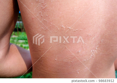 The man received sunburn on the seashore. The skin 98683912