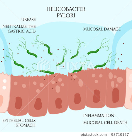 Helicobacter pylori in mucosal layer on inflamed epithelial cells in stomach 98710127