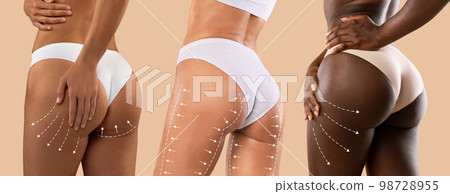 Millennial different women in bikini with perfect skin, slim body with lines for figure shaping, drainage massage 98728955