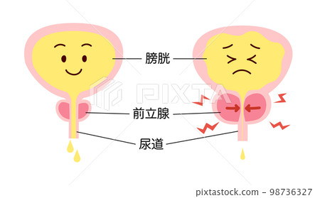 Explanation comparison illustration of normal and enlarged prostate 98736327