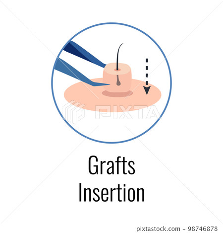 Alopecia Grafts Insertion Composition Alopecia Grafts Insertion Composition 98746878