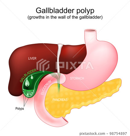 Cross section of a Gallbladder with polyps 98754897