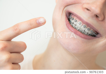 Close-up portrait of a young woman pointing at a smile with braces on her teeth. 98761303