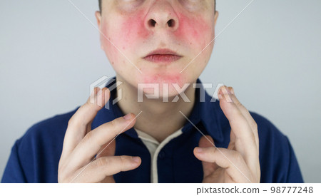 Rosacea face. The man suffers from redness on her cheeks. Couperose of the skin. Redness and capillary mesh are visible on the face. Treatment and removal. Vascular surgery and dermatology Rosacea face. The man suffers from redness on her cheeks. Couperose of the skin. Redness and capillary mesh are visible on the face. Treatment and removal. Vascular surgery and dermatology 98777248