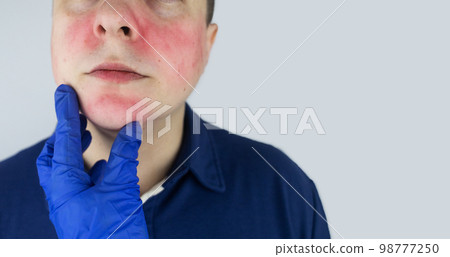 Rosacea face. The man suffers from redness on her cheeks. Couperose of the skin. Redness and capillary mesh are visible on the face. Treatment and removal. Vascular surgery and dermatology Rosacea face. The man suffers from redness on her cheeks. Couperose of the skin. Redness and capillary mesh are visible on the face. Treatment and removal. Vascular surgery and dermatology 98777250