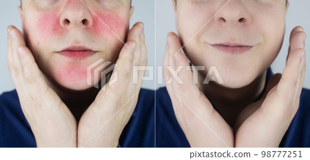 Rosacea face. The man suffers from redness on her cheeks. Couperose of the skin. Redness and capillary mesh are visible on the face. Treatment and removal. Vascular surgery and dermatology Rosacea face. The man suffers from redness on her cheeks. Couperose of the skin. Redness and capillary mesh are visible on the face. Treatment and removal. Vascular surgery and dermatology 98777251