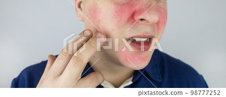 Rosacea face. The man suffers from redness on her cheeks. Couperose of the skin. Redness and capillary mesh are visible on the face. Treatment and removal. Vascular surgery and dermatology Rosacea face. The man suffers from redness on her cheeks. Couperose of the skin. Redness and capillary mesh are visible on the face. Treatment and removal. Vascular surgery and dermatology 98777252