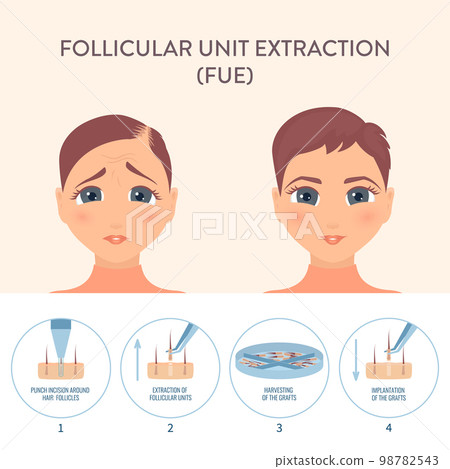 Female hair transplantation procedure medical infographic poster 98782543