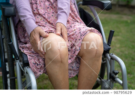 Asian senior or elderly old lady woman patient show her scars surgical total knee joint replacement Suture wound surgery arthroplasty on bed in nursing hospital ward, healthy strong medical concept. 98795629