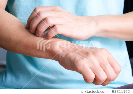 man's hand where he scratched his arm and wrist, he had itchy, inflamed skin and felt itchy. 98811163