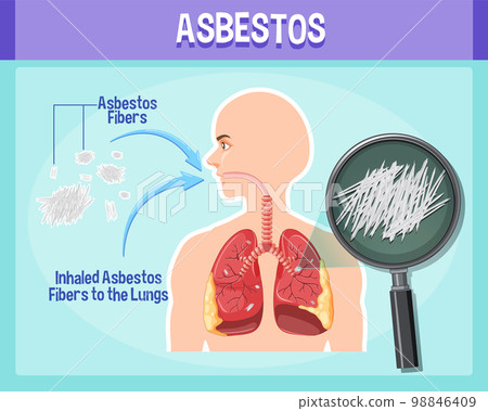 Diagram showing asbestosis in lungs Diagram showing asbestosis in lungs 98846409
