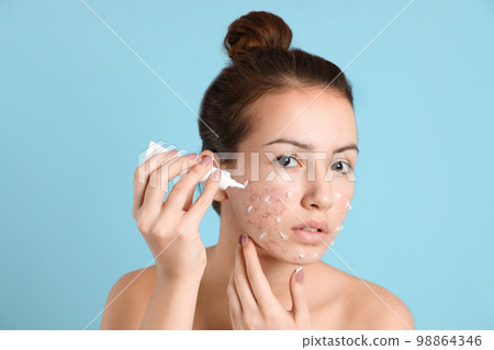 Teen girl with acne problem applying cream on light blue background Teen girl with acne problem applying cream on light blue background 98864346