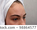 Acne. forehead. Teenage girl with the pimples on her face. 98864577