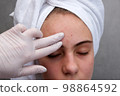 Acne. Teenage girl with the pimples on her face. Problematic skin. 98864592