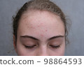 Acne. Teenage girl with the pimples on her face. Problematic skin. Close-up. 98864593