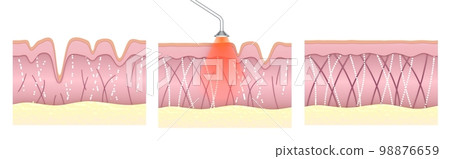 Laser skin resurfacing. Comparison of skin tissue before and after laser anti-aging treatment. Wrinkled irregular skin with poor collagen levels becomes smooth and elastic 98876659