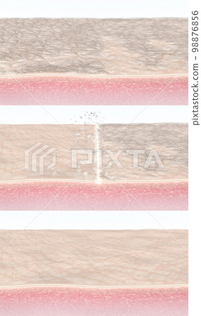 Skin peel. Human skin fibers cross-section before and after chemical peeling, laser resurfacing, microdermabrasion, or other beauty treatment procedure. 3d rendered step-by-step illustration  98876856