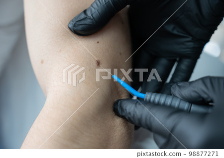 Dermatologist removes a mole on a patient's arm using an electrocoagulator. Dermatologist removes a mole on a patient's arm using an electrocoagulator. 98877271