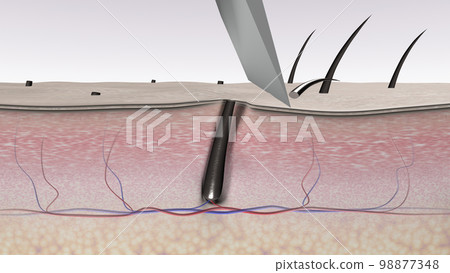 Hair shaving with bad results. A razor blade - Stock 