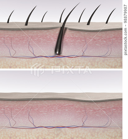 Skin before and after hair removal. Skin tissues and hair follicle cross-section. 3d rendered illustration 98879987