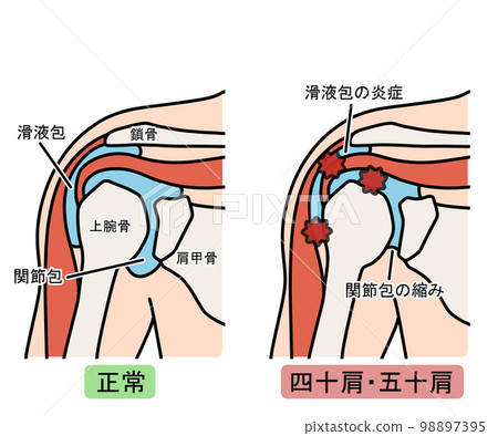 40肩/50肩 40肩/50肩 98897395
