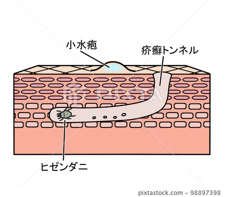 Scabies (with text) - Stock Illustration [98897398] - PIXTA
