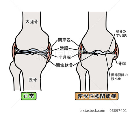 Osteoarthritis of the knee 98897401