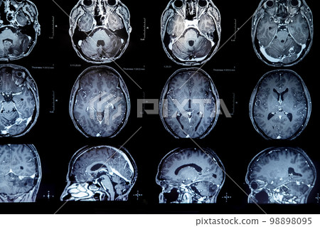 mri with brain tumor. Magnetic resonance imaging. mri with brain tumor. Magnetic resonance imaging. 98898095
