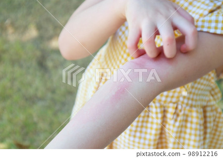 Little girl has skin rash allergy and itchy on her arm 98912216