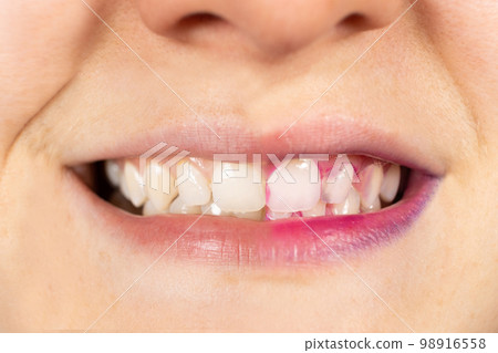A woman's teeth before and after using indicator pills to determine plaque. A woman's teeth before and after using indicator pills to determine plaque. 98916558