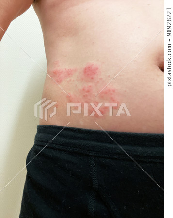 abdominal shingles abdominal shingles 98928221