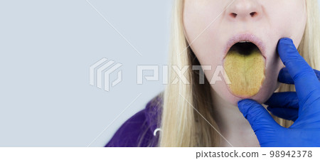 Woman has a yellow tongue. Painful yellow coating on the mucous membrane of the tongue. Diseases of the gastrointestinal tract, liver and gallbladder. The consequences of taking antibiotics. Woman has a yellow tongue. Painful yellow coating on the mucous membrane of the tongue. Diseases of the gastrointestinal tract, liver and gallbladder. The consequences of taking antibiotics. 98942378