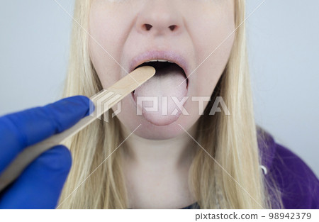 Woman has a white tongue. Painful white coating on the mucous membrane of the tongue. Diseases of the gastrointestinal tract, liver and gallbladder. The consequences of taking antibiotics. Woman has a white tongue. Painful white coating on the mucous membrane of the tongue. Diseases of the gastrointestinal tract, liver and gallbladder. The consequences of taking antibiotics. 98942379
