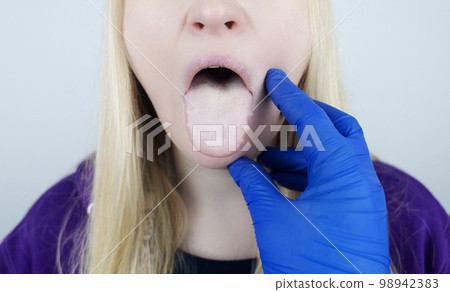 Woman has a white tongue. Painful white coating on the mucous membrane of the tongue. Diseases of the gastrointestinal tract, liver and gallbladder. The consequences of taking antibiotics. Woman has a white tongue. Painful white coating on the mucous membrane of the tongue. Diseases of the gastrointestinal tract, liver and gallbladder. The consequences of taking antibiotics. 98942383