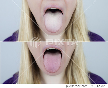 Woman has a white tongue. Painful white coating on the mucous membrane of the tongue. Diseases of the gastrointestinal tract, liver and gallbladder. The consequences of taking antibiotics. Woman has a white tongue. Painful white coating on the mucous membrane of the tongue. Diseases of the gastrointestinal tract, liver and gallbladder. The consequences of taking antibiotics. 98942384