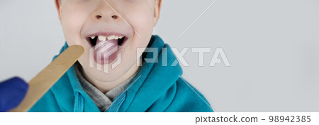 Blond boy has a white tongue. Painful white coating on the mucous membrane of the tongue. Diseases of the gastrointestinal tract, liver and gallbladder. The consequences of taking antibiotics. Blond boy has a white tongue. Painful white coating on the mucous membrane of the tongue. Diseases of the gastrointestinal tract, liver and gallbladder. The consequences of taking antibiotics. 98942385